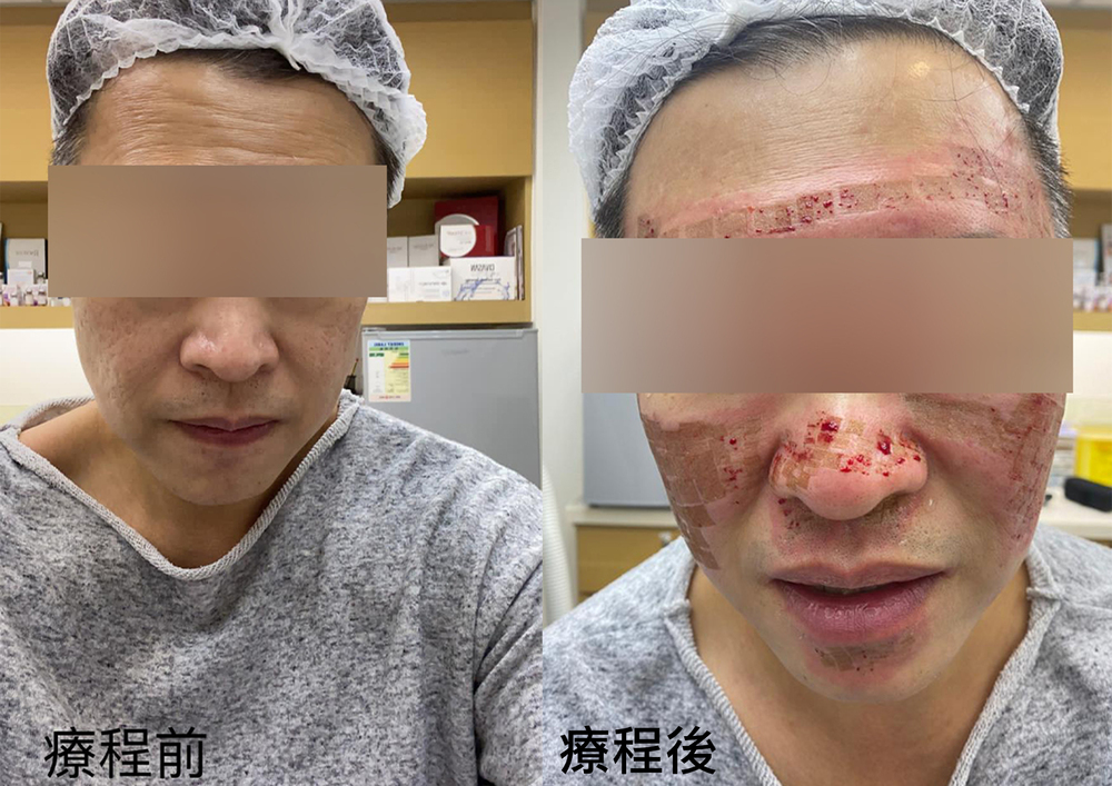 The 40-year-old, who provided photos to back his claim, said he was yelling in pain during the wart-removal treatment, but the doctor refused to stop. Right: the equipment used. The 40-year-old, who provided photos to back his claim, said he was yelling in pain during the wart-removal treatment, but the doctor refused to stop. Right: the equipment used.
