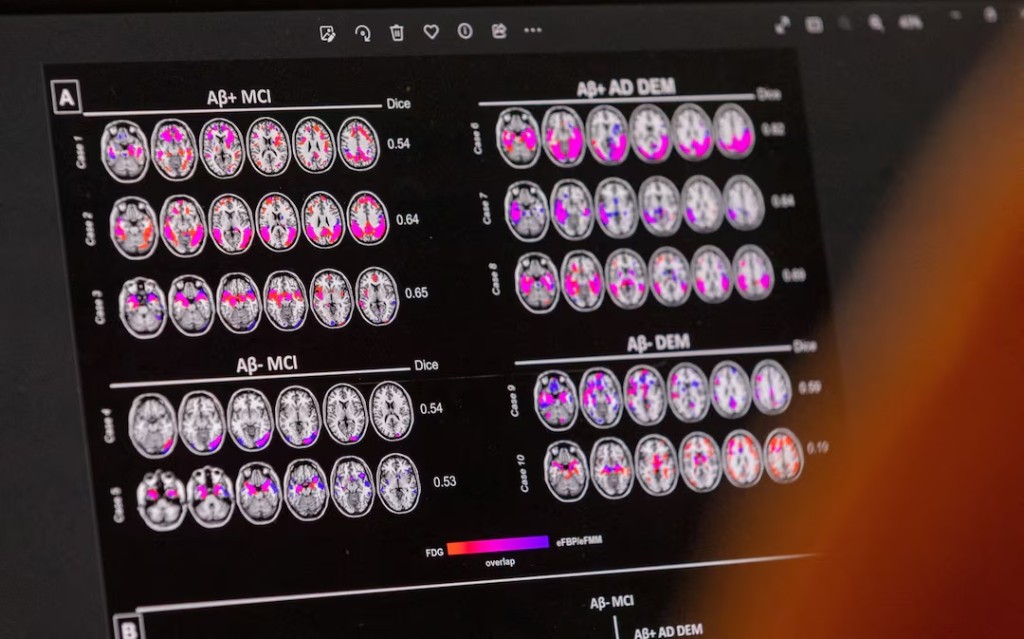 A scientist looks at hypometabolic and hypoperfusion patterns at the single-subject level from a patient suffering from Alzheimer's disease at the Memory Centre at the Department of Readaptation and Geriatrics of the University Hospital (HUG), in Geneva, Switzerland, June 6, 2023. REUTERS/Denis Balibouse/File Photo