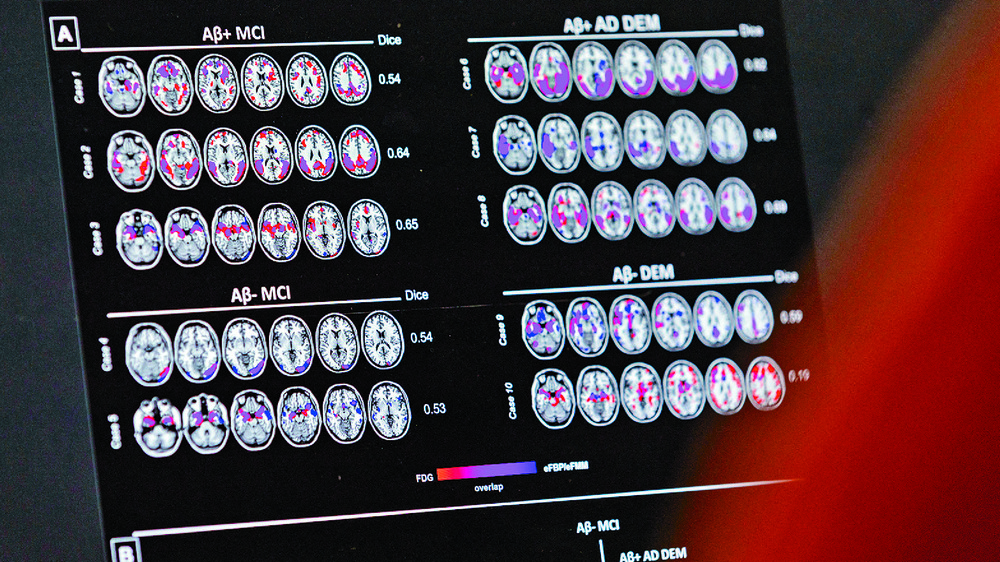 Researchers found 1,463 proteins associated with dementia. Reuters Researchers found 1,463 proteins associated with dementia. Reuters