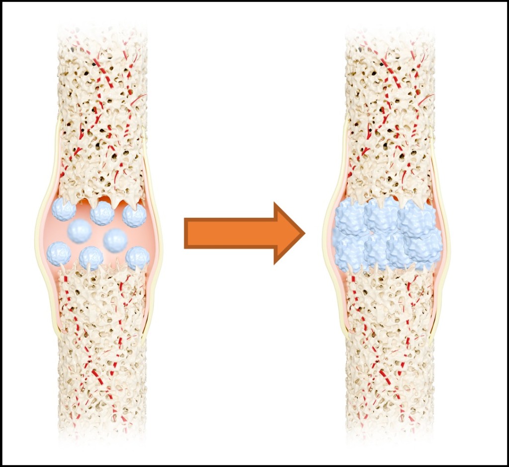 The 'nano-artificial bone material', which closely resembles human bone, exhibits exceptional elasticity, toughness and strength. It can provide stability and promote bone healing. The 'nano-artificial bone material', which closely resembles human bone, exhibits exceptional elasticity, toughness and strength. It can provide stability and promote bone healing.