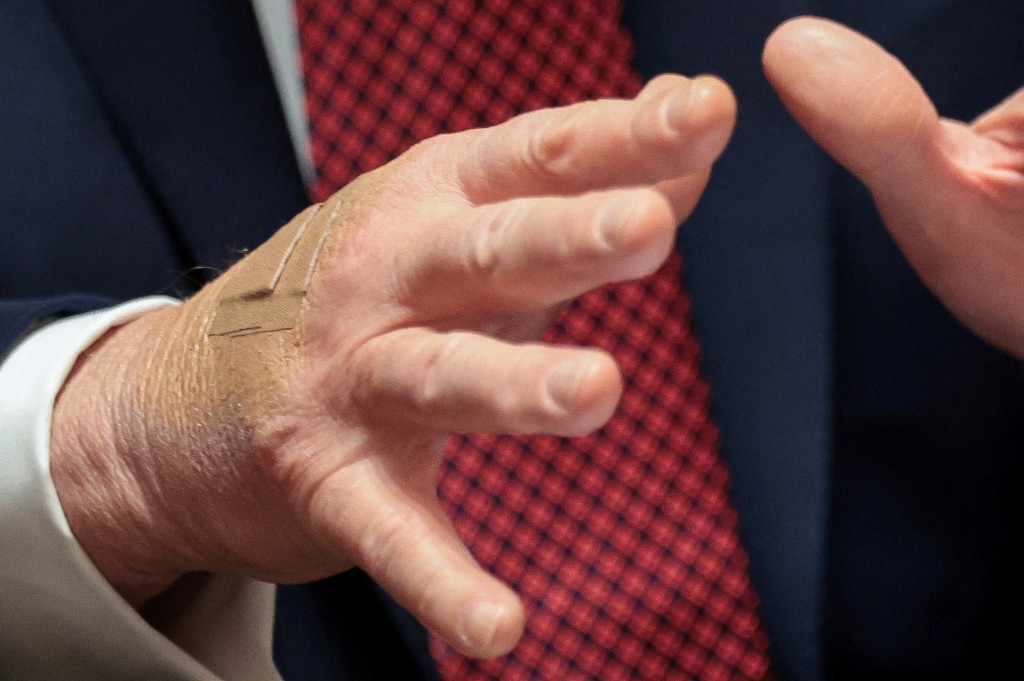 Adhesive bandages on U.S. President Donald Trump's right hand as he gestures during a roundtable discussion on the day he announced an aid package for farmers, at the White House in Washington, D.C., U.S., December 8, 2025. REUTERS/Jonathan Ernst