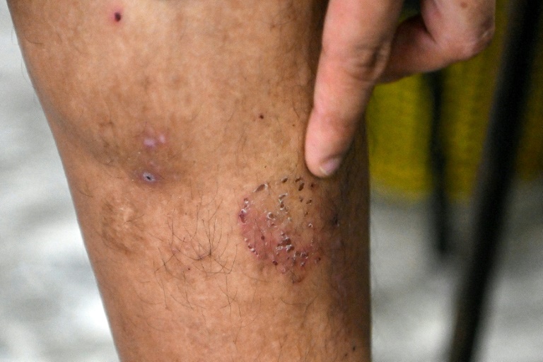 A victim of a Chinese scamming gang shows a scar on his leg after he was tortured. (AFP)