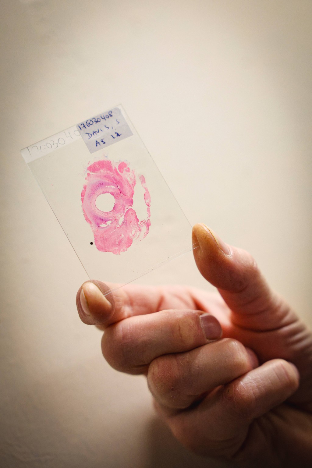 Photo by ADRIAN DENNIS / AFP  This photo taken on January 14, 2026 shows a cross section of a cancer sample removed in surgery, sandwiched between two slides, pictured in a storeroom at St Mark’s hospital at Northwick Park in Harrow, west London.