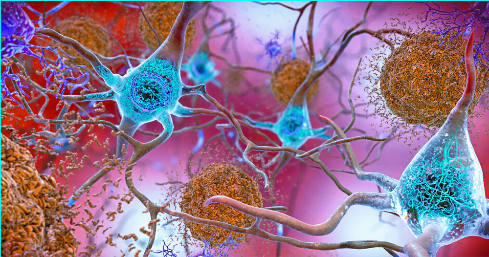 Two key proteins – tau and amyloid beta – build into plaques which cause brain cells to die. Lecanemab targets those proteins. AP Two key proteins – tau and amyloid beta – build into plaques which cause brain cells to die. Lecanemab targets those proteins. AP