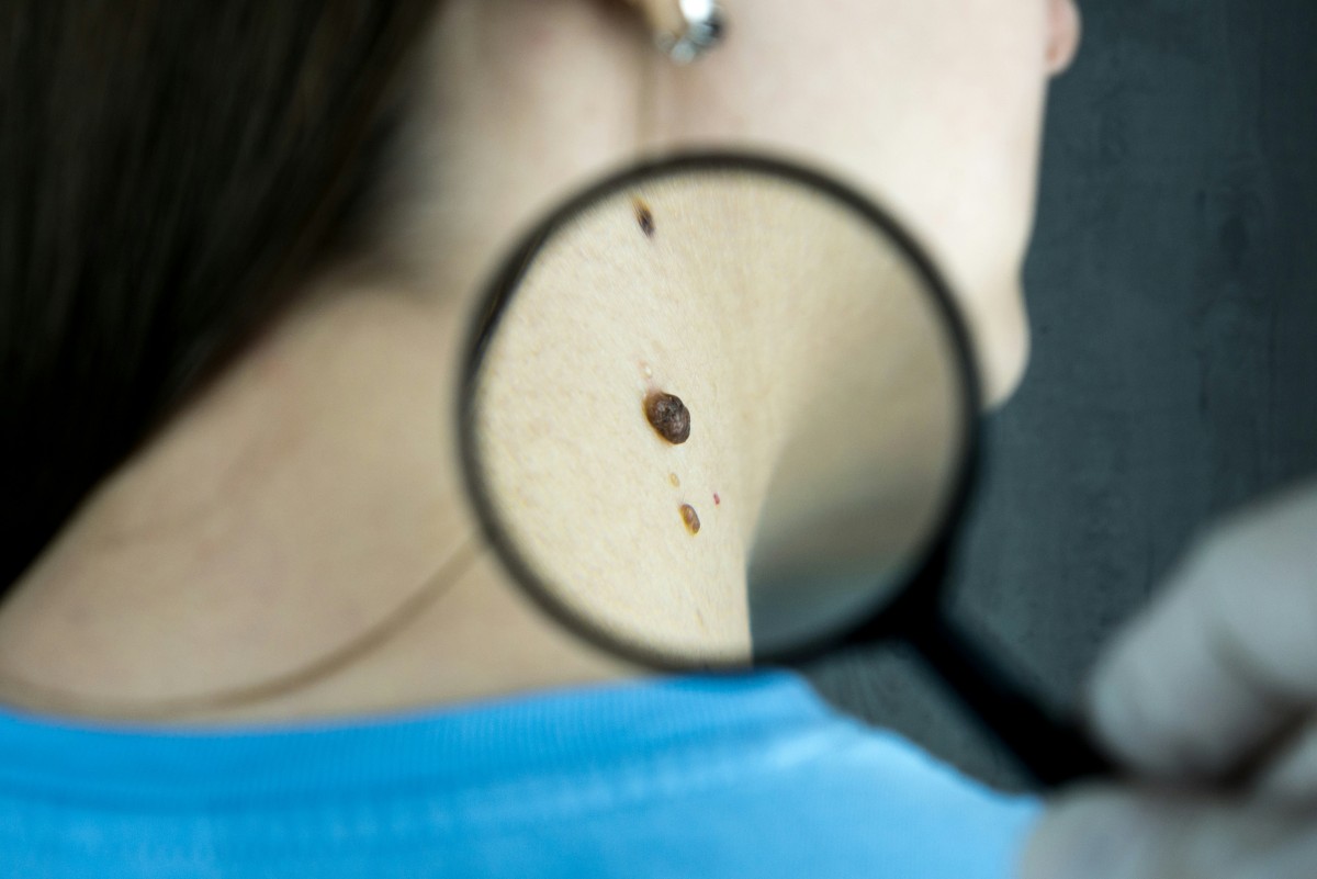 thestandard.com.hk - Khan Heeba Lazmi - Man's lip 'pimple' persisted for 6 years - Medical examination revealed skin cancer